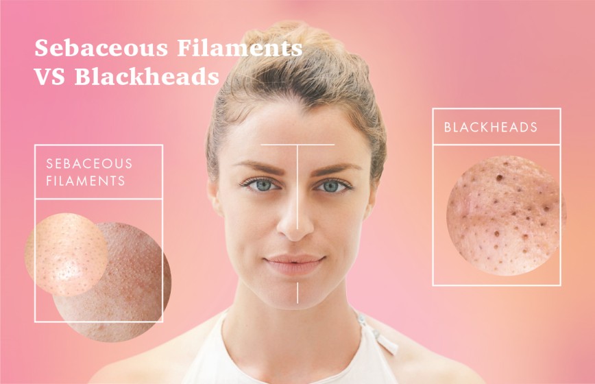 How To Get Rid Of Sebaceous Filaments? Treatments, And More 2024